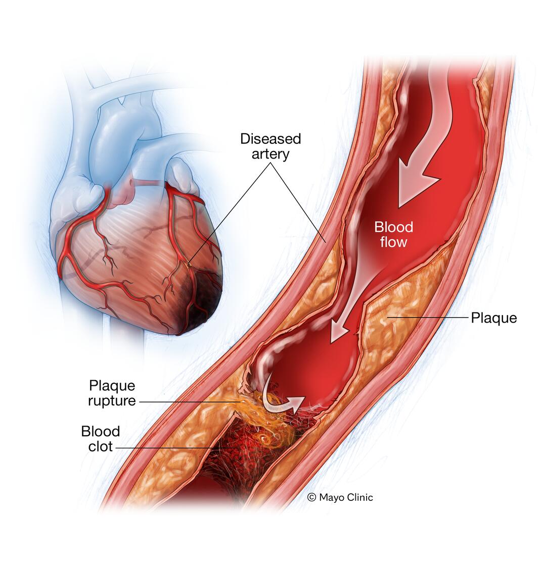 Ischemic Cardiomyopathy Symptoms Causes 51 OFF
