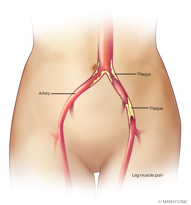 Claudicación - Síntomas y causas - Mayo Clinic