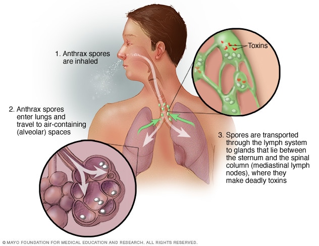 Anthrax - Symptoms & causes - Mayo Clinic