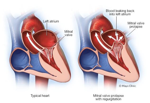 Mitral valve prolapse - Symptoms & causes - Mayo Clinic