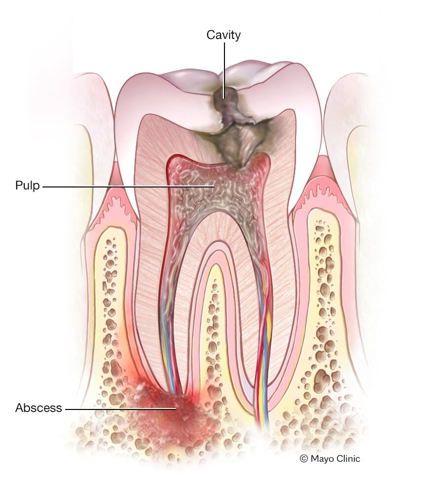 Is My Tooth Infected?  