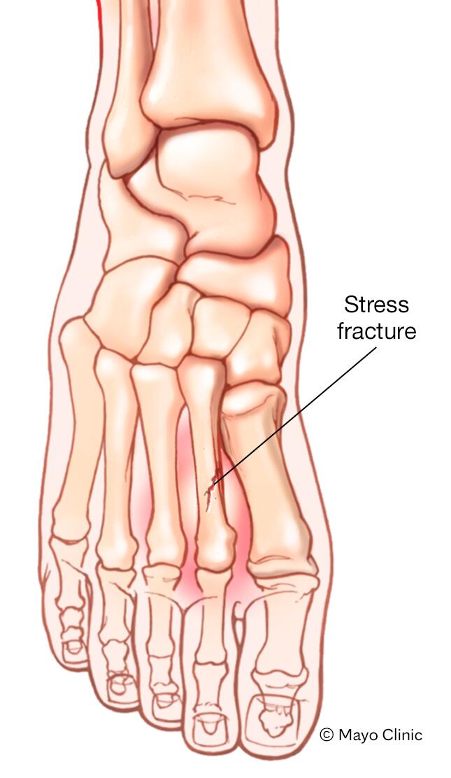 Stress fractures - Symptoms & causes - Mayo Clinic