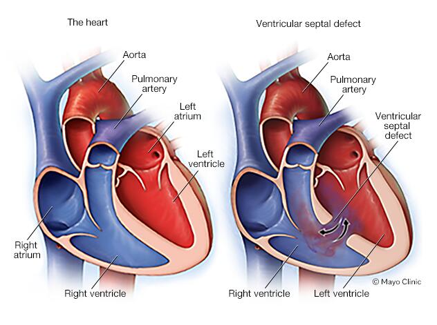 congenital heart disease