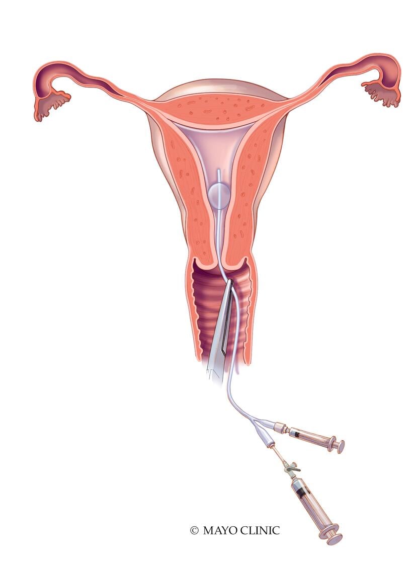 Female infertility - Diagnosis & treatment - Mayo Clinic