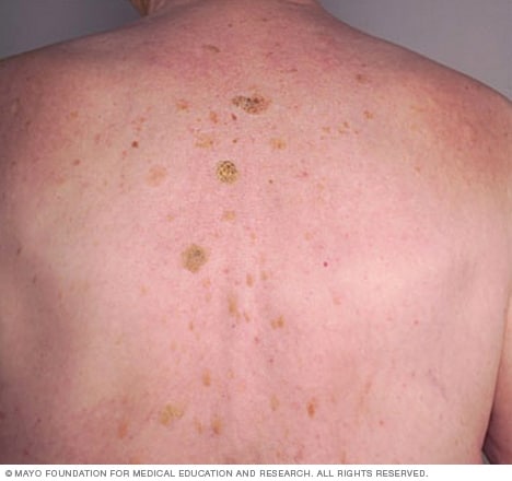 Seborrheic keratosis Symptoms causes Mayo Clinic