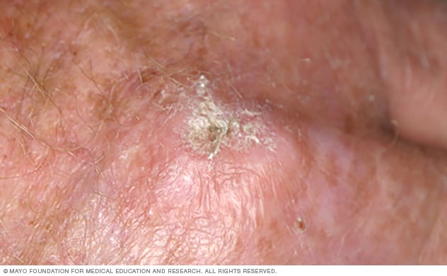 Actinic keratosis Symptoms causes Mayo Clinic