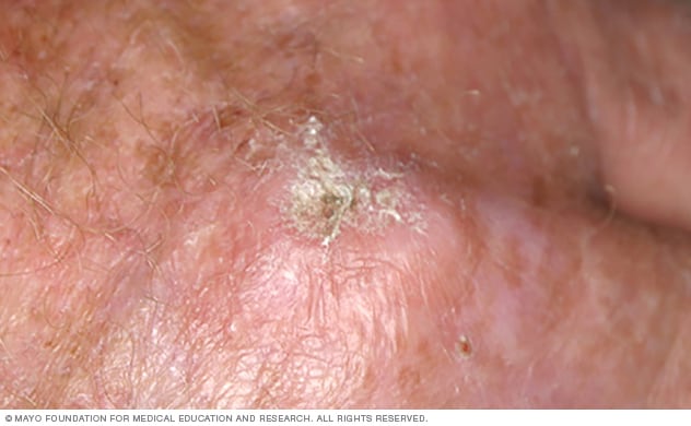 Age spots (liver spots) - Symptoms & causes - Mayo Clinic