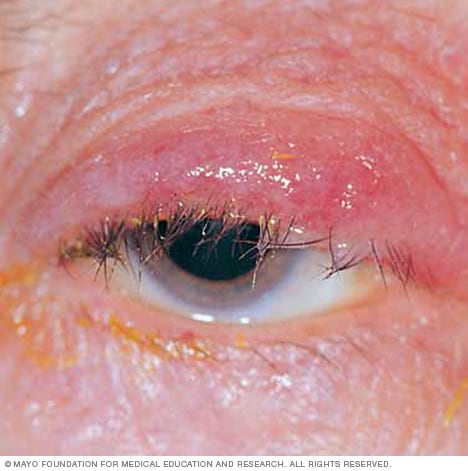 Blepharitis Symptoms causes Mayo Clinic