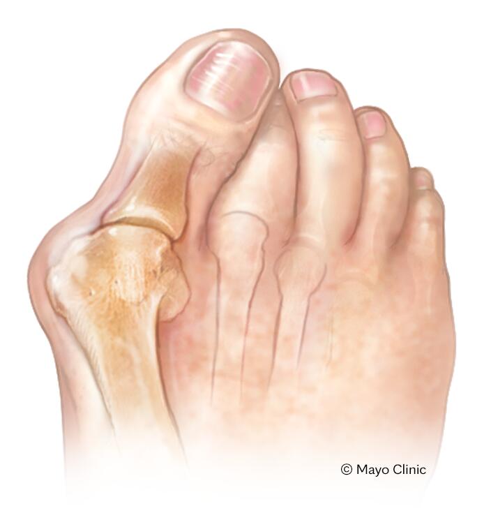 Bunions - Symptoms & causes - Mayo Clinic