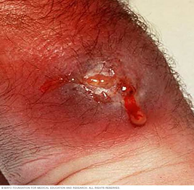 Staph Infection: Causes, Symptoms, Diagnosis & Treatment