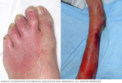 Fascitis plantar - Mayo Clinic