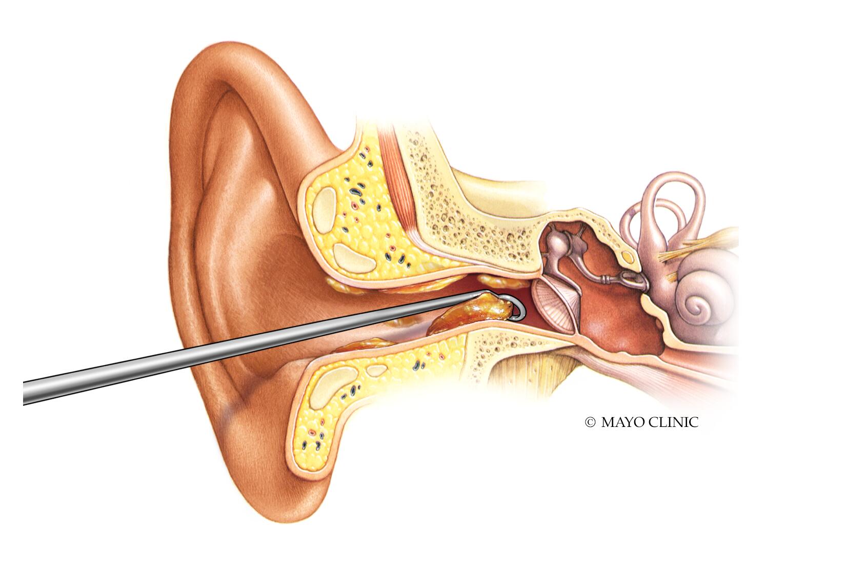 Conos para remover cerumen