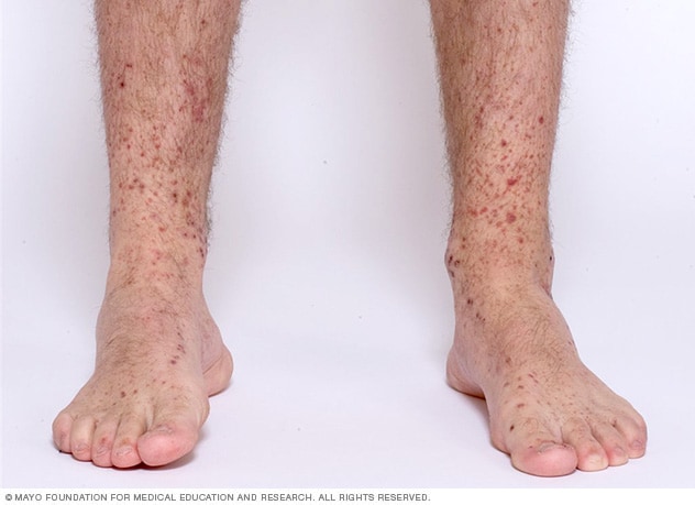 Henoch-Schonlein purpura - Symptoms & causes - Mayo Clinic