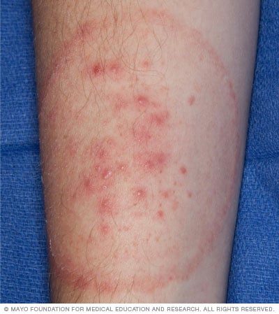 Skin Infection Pictures: Ringworm, Fungal Infections & More