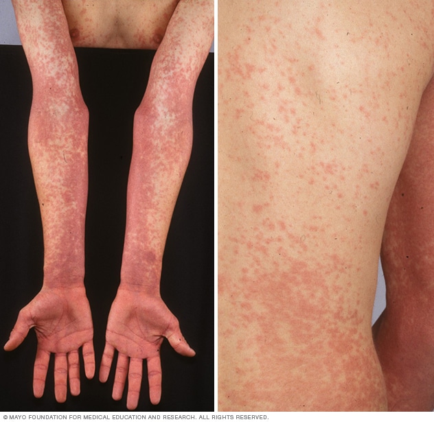 Scarlet fever rash: Symptoms, diagnosis, and treatment