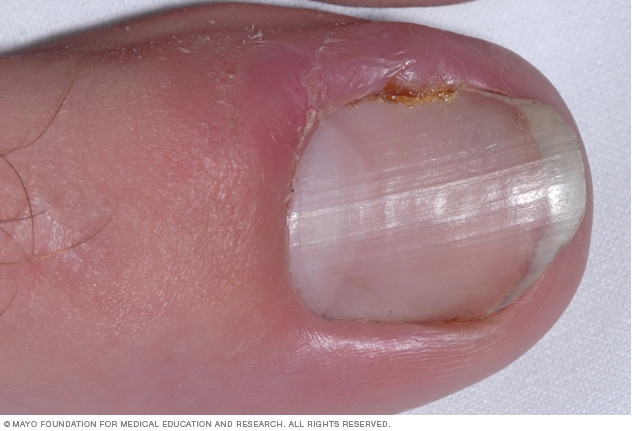 Fungus Infection on Nails Hand, Finger with onychomycosis, A toenail fungus.  - soft focus Stock Photo by ©n.nonthamand.gmail.com 120822644