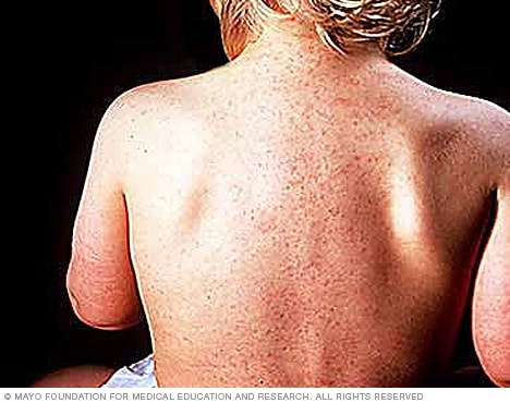 Roseola - Symptoms & causes - Mayo Clinic