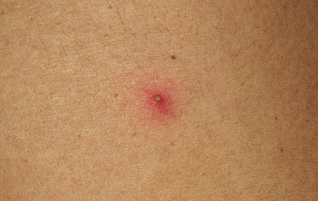 Bumps on legs that on sale look like pimples