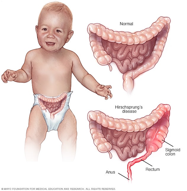 A composite of three illustrations showing a baby, normal intestines and intestines affected by Hirschsprung's disease. 
