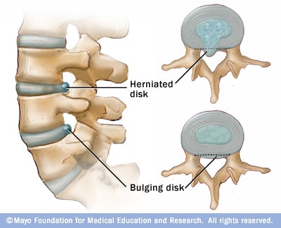The Spinal Series: Bulging Disc