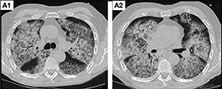 Images of diffuse alveolar hemorrhage