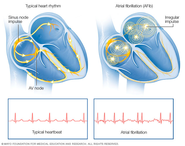 Atrial fibrillation - Mayo Clinic