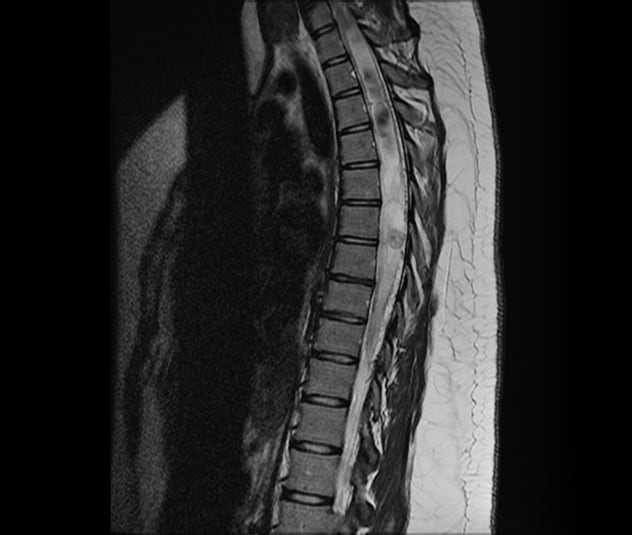 T2-weighted MRI of extensive syrinx associated with an intramedullary hemangioblastoma