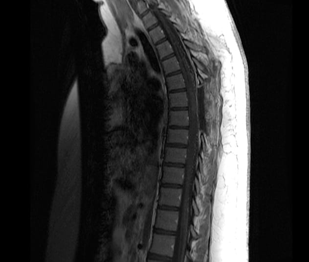 Postoperative MRI shows no residual tumor and resolution of the syrinx