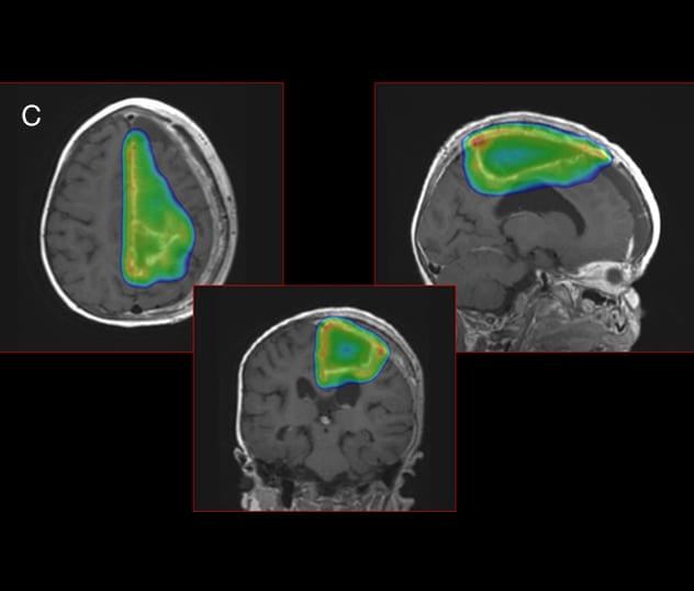 Proton beam therapy used to avoid toxicity in surrounding brain tissue