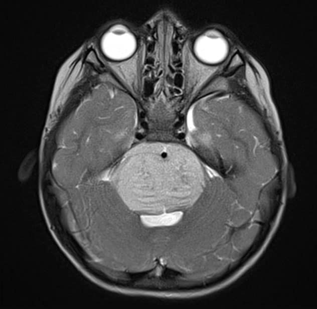 Axial T2-weighted MRI scan with contrast