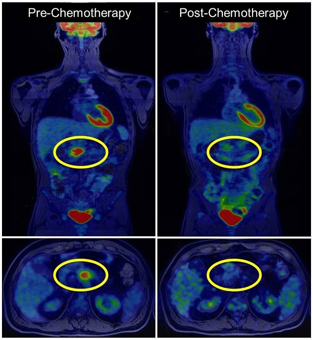 PET scan for pancreatic cancer