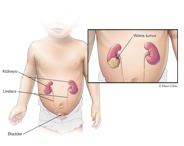 Wilms tumor on kidney