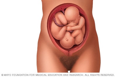 Illustration of twins before birth