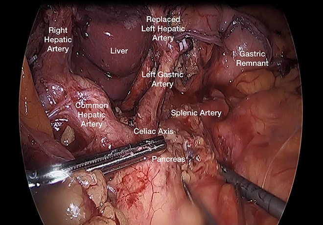 Laparoscopic gastrectomy